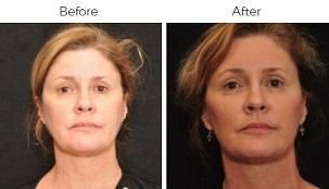 Brow Lift Before & After