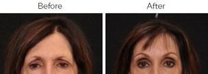Brow Lift Before & After