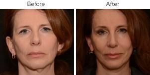 Brow Lift Before & After