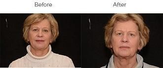 Brow Lift Before & After