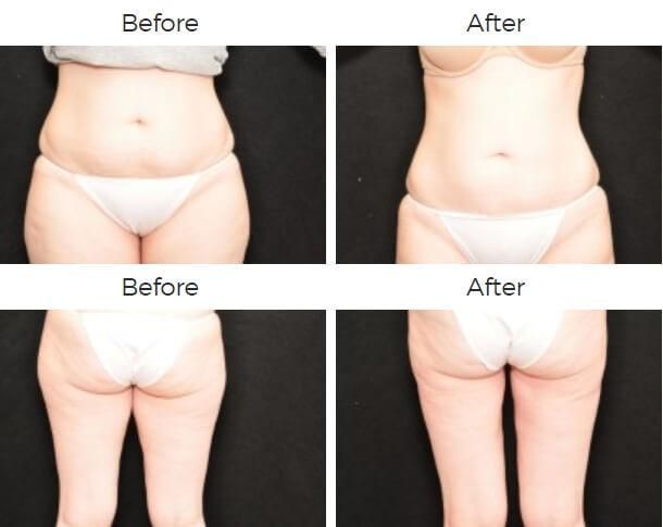 Liposuction Before & After