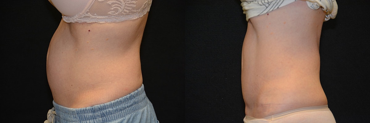 Liposuction Before & After