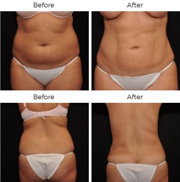 Liposuction Before & After