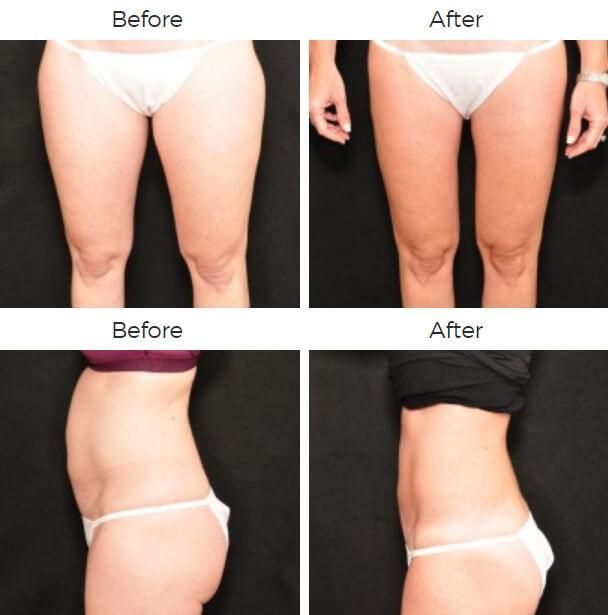 Liposuction Before & After
