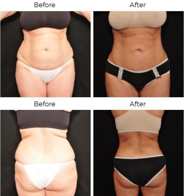 Liposuction Before & After