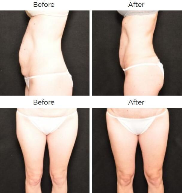 Liposuction Before & After