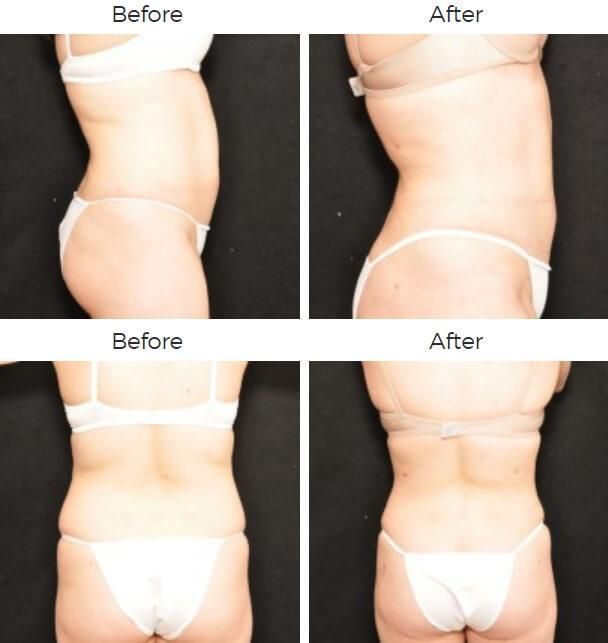 Liposuction Before & After