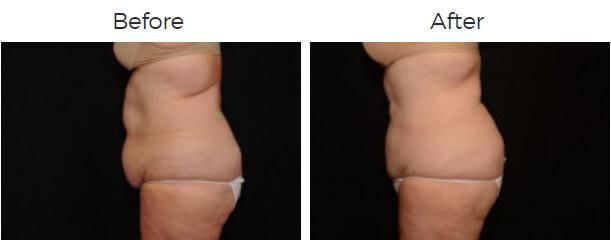 Liposuction Before & After