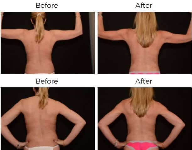 Liposuction Before & After