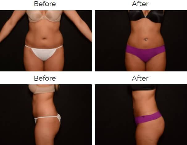 Liposuction Before & After