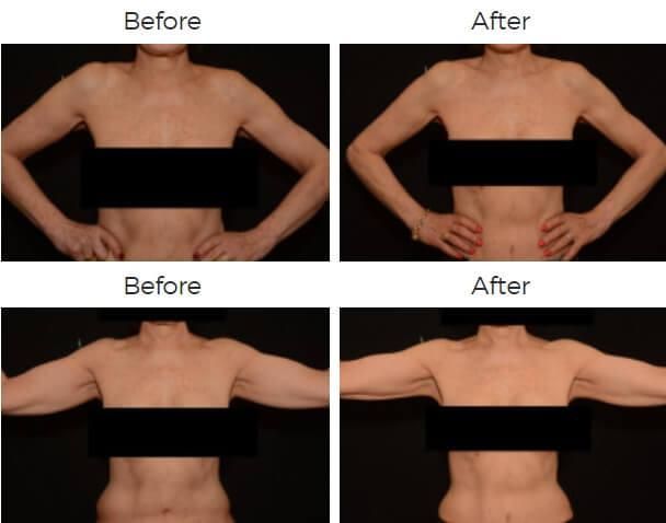 Liposuction Before & After
