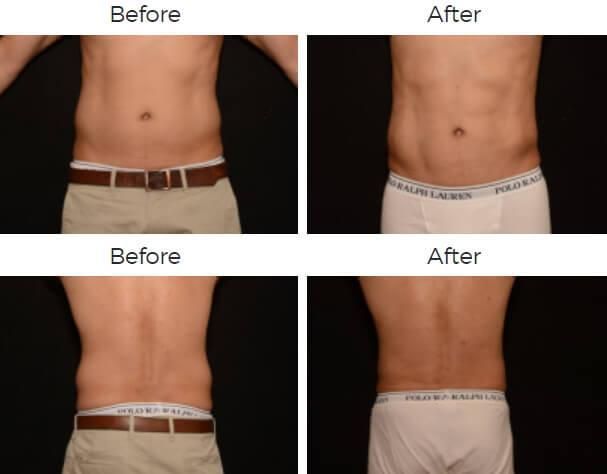 Liposuction Before & After