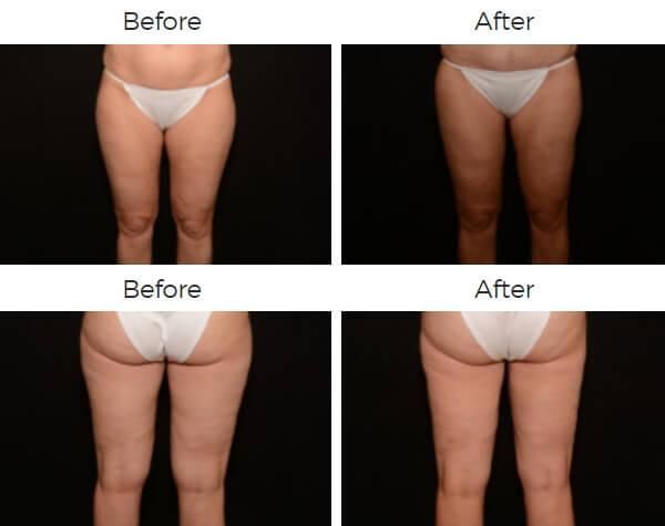 Liposuction Before & After