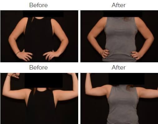 Liposuction Before & After