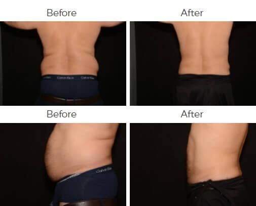 Liposuction Before & After