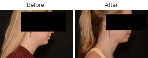 Liposuction Before & After