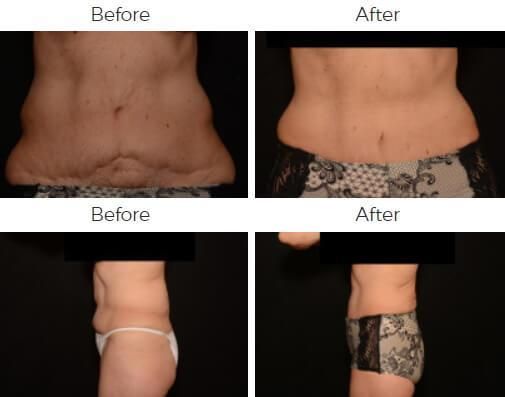Liposuction Before & After