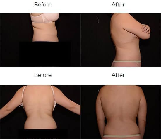 Liposuction Before & After