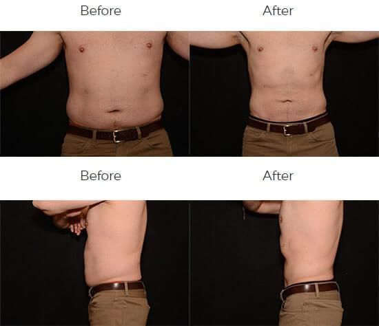 Liposuction Before & After