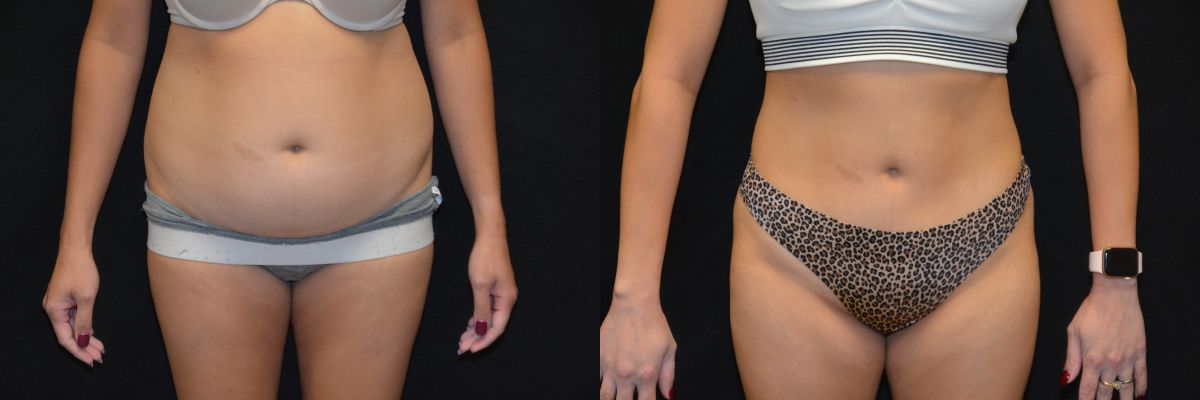 Liposuction Before & After