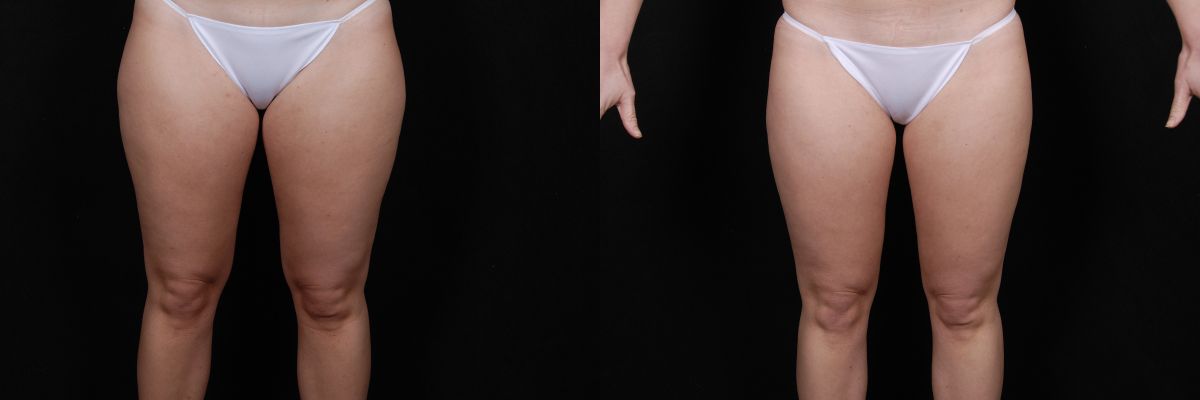 Liposuction Before & After
