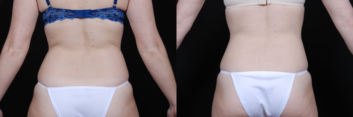 Liposuction Before & After
