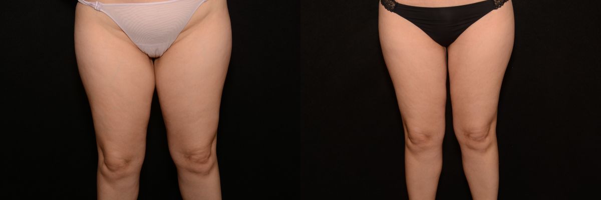 Liposuction Before & After