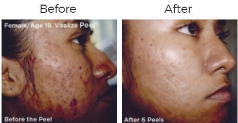 Vitalize Peel Before & After
