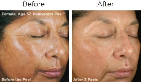 Vitalize Peel Before & After