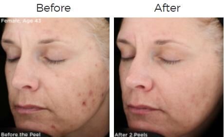Vitalize Peel Before & After
