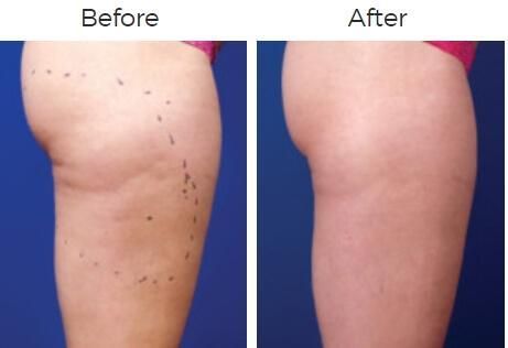 Venus Legacy Before & After