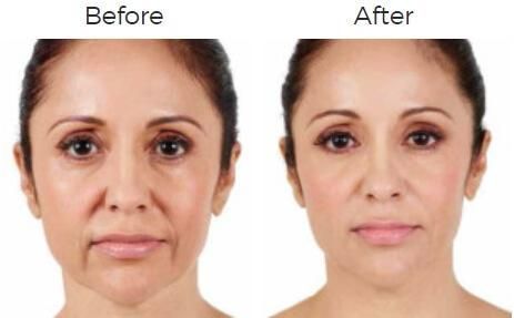Juvederm Before & After