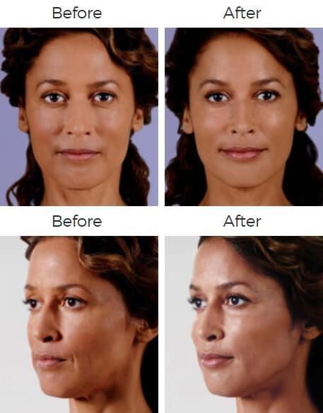 Juvederm Before & After