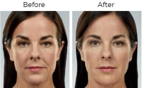 Juvederm Before & After