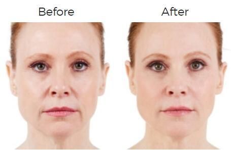 Juvederm Before & After