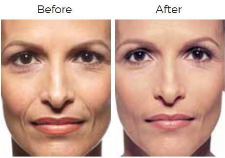 Juvederm Before & After