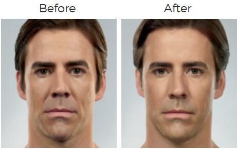 Juvederm Before & After