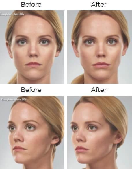 Juvederm Before & After