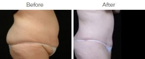 Tummy Tuck Before & After