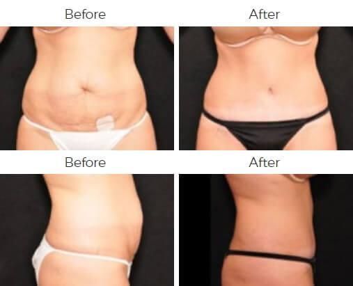 Tummy Tuck Before & After
