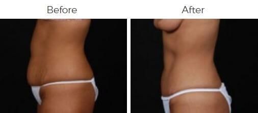 Tummy Tuck Before & After