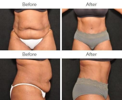 Tummy Tuck Before & After