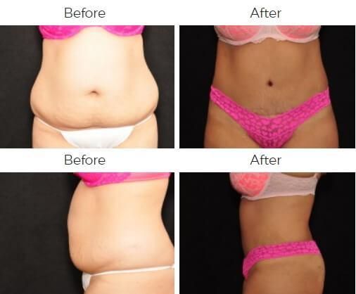 Tummy Tuck Before & After