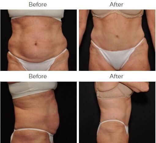 Tummy Tuck Before & After