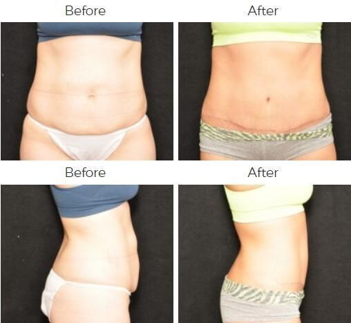 Tummy Tuck Before & After
