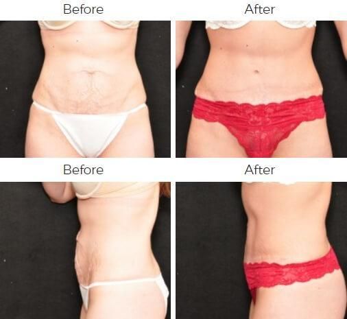 Tummy Tuck Before & After