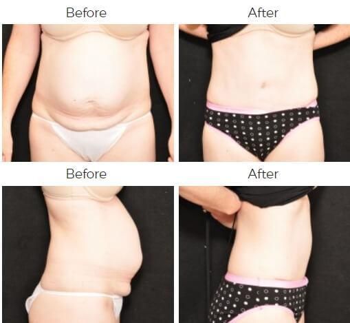 Tummy Tuck Before & After