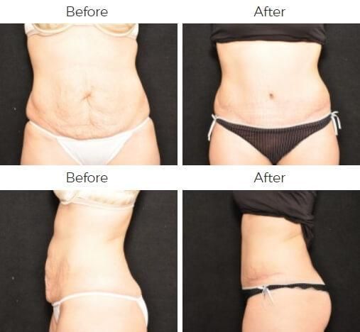 Tummy Tuck Before & After