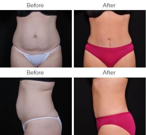 Tummy Tuck Before & After