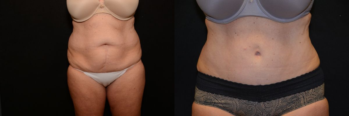Tummy Tuck Before & After